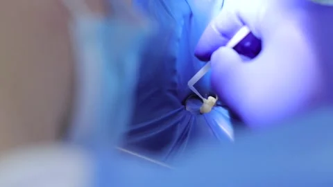 Dentist close-up tool treating teeth Professional doctor stomatologist Stock Footage 153939083