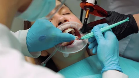 Dentist curing adhesive with UV light during aligner bonding procedure on t.. Stock Footage 305500371