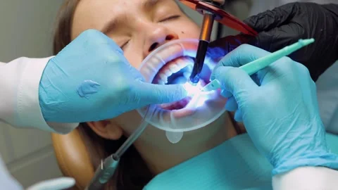 Dentist curing adhesive with UV light during aligner bonding procedure on t.. Stock Footage 305500422