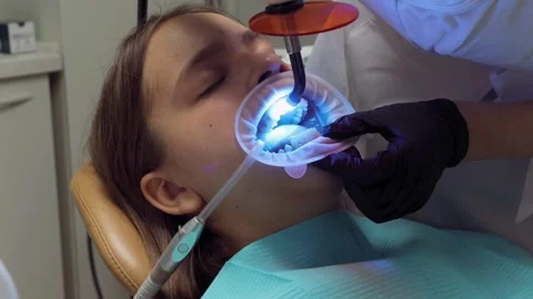 Dentist curing adhesive with UV light during aligner bonding procedure on t.. Stock Footage 305500470