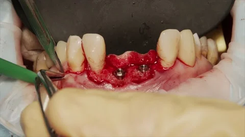 The dentist cuts the gum Stock Footage 160608631