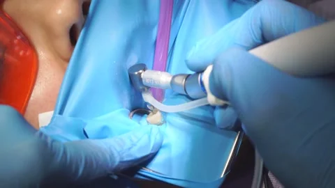 Dentist demonstrates the work of the device to clean the channels of teeth Stock Footage 148068809