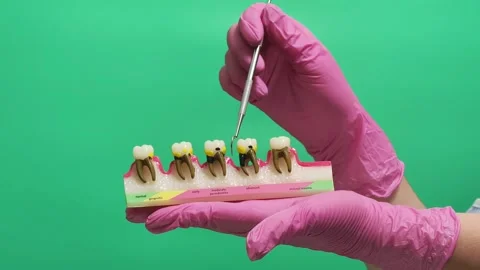 Dentist Demonstrating Tooth Decay with Dental Model and Diseased Tooth Stock Footage 337106491