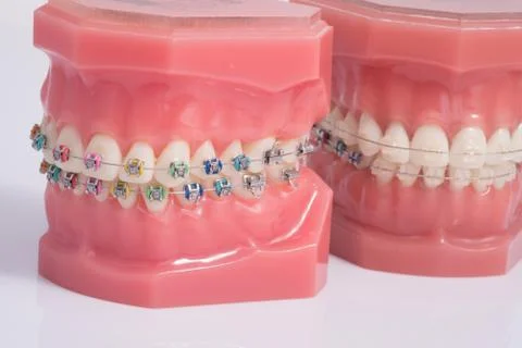 Dentist demonstration teeth model of varities of orthodontic bracket . Stock Photos