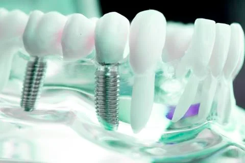 Dentist dental teeth implant Stock Photos