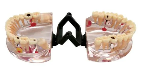 Dentist denture model with teeth and cavities isolated on white background Foto stock