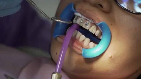 Dentist doing orthodontic, placing brackets to a asian girl Video stock 187690990