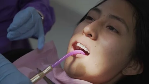 Dentist doing orthodontics, placing brackets, hooks, archwires and elastic Video stock 187690568