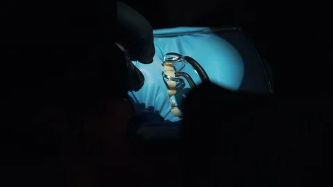 A dentist doing surgery close-up Stock Footage 112132512
