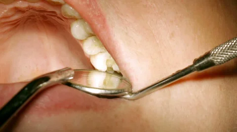 Dentist Drilling And Removing Old Fillings Stock-Footage 33401022