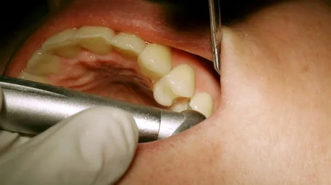 Dentist Drilling Cavities In Molars Stock-Footage 33401241