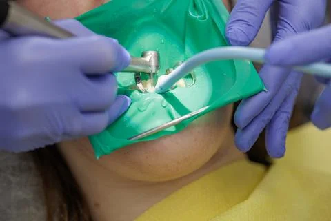 Dentist drilling tooth under rubber dam during dental treatment Stock Photos