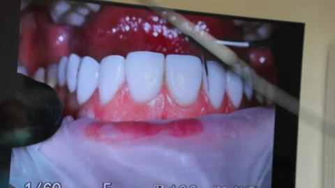 A dentist examines installed veneers in a modern clinic Stock Footage 235675862
