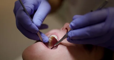 Dentist examines patient in closeup, showcasing dental procedures in a modern Vídeo Stock 322623018