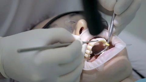 Dentist examing patient's teeth, using probe and dental mirror. Close-up. 스톡 동영상 102842374