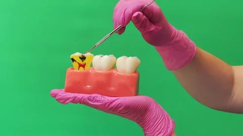 Dentist Examining Cross Section Molar with Tooth Decay on Green Screen Stock Footage 337106703