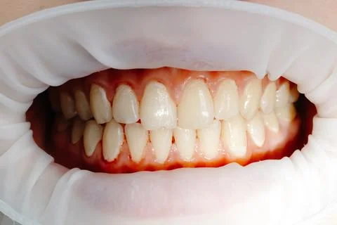 Dentist examining patient teeth using cheek retractor during dental procedure Stock Photos