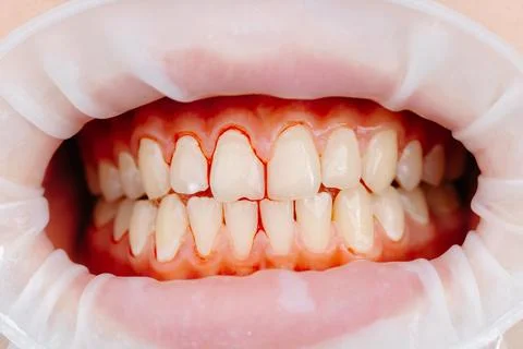 Dentist examining patient teeth using cheek retractor during dental procedure Stock Photos