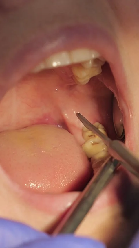 Dentist examining a patients decayed molar tooth for cavities during a dental Stock-Footage 341579307