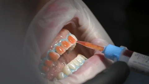 Dentist Examining Patient's Teeth Stock Footage 87861490