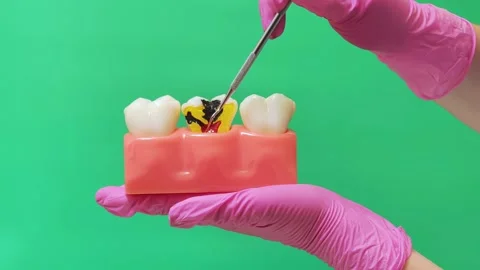 Dentist Examining Severe Tooth Decay on Molar Model Against Green Screen Stock Footage 337106652