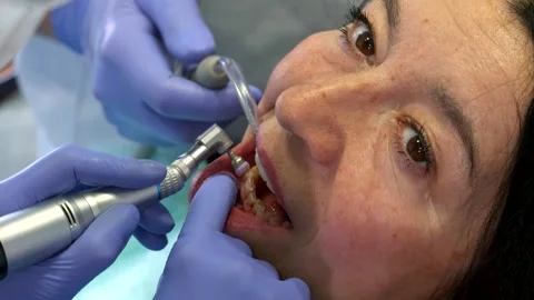 Dentist expertly changes the brush of a prophy cup during a dental procedure Stock Footage 311938636