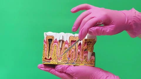 Dentist Explaining Root Canal, Dental Implant and Gum Disease on Jaw Model Stock Footage 337106632