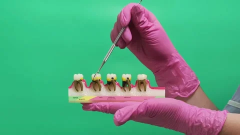 Dentist Explaining Stages of Tooth Decay on Dental Model Against Green Screen Stock Footage 337106497