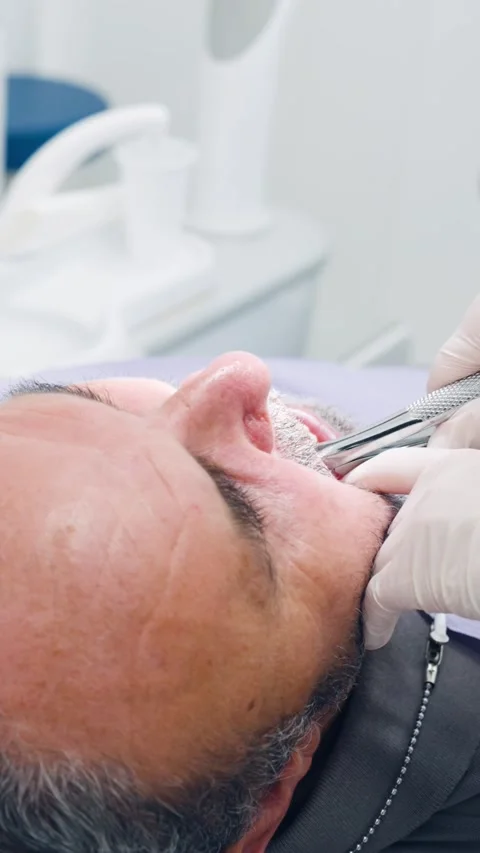 Dentist extracting tooth using forceps from patient's mouth. Vertical Stock Footage 335389946