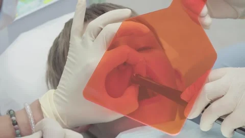 Dentist glues chipped tooth of boy while assistant uses UV light for glue curing Stockbeeldmateriaal 330482753