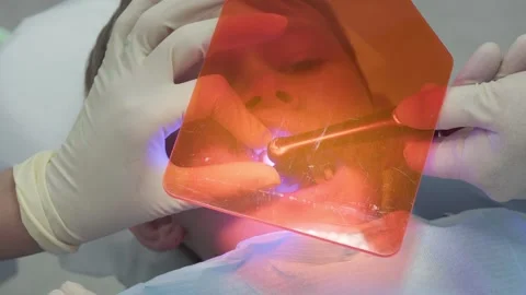 Dentist glues chipped tooth while assistant uses UV light for filling composite Stockbeeldmateriaal 330483382