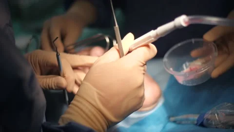 Dentist Grafting the Socket of Patient Stock Footage 148493975