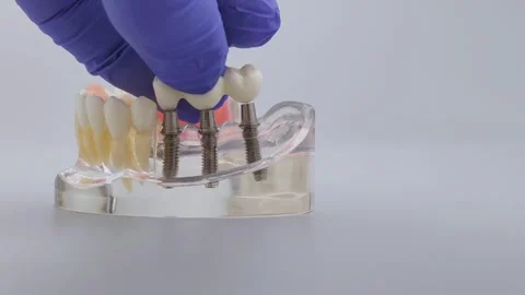 Dentist hand in blue glove placing dental bridge on implant jaw model Stock Footage 340052384