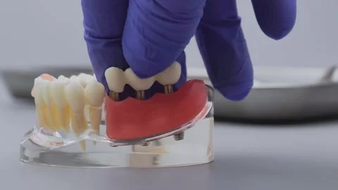 Dentist hand in blue glove placing dental bridge on implant jaw model Stock Footage 340052386