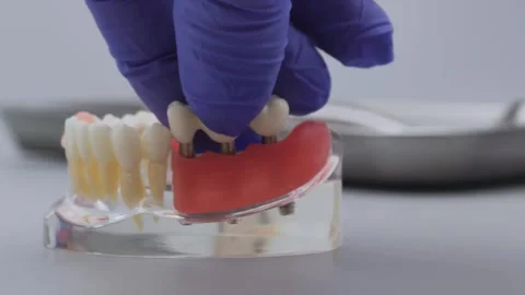 Dentist hand in blue glove placing dental bridge onto implant jaw model Stock Footage 340052397