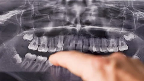 Dentist hand pointing on X-ray of teeth, close-up. Dentist checking at dent.. Stock Footage 295355473