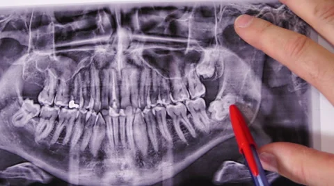 Dentist Impacted Wisdom Teeth Xray Closeup Stock Footage 63257697