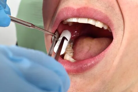 The dentist inserts the swab Foto stock