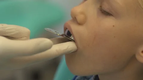 Dentist makes a bite cast in a child Stock Footage 115910105
