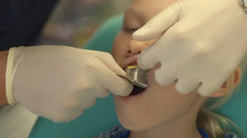 Dentist makes a bite cast in a child Stock Footage 115910163