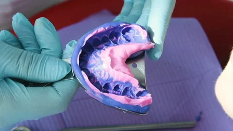 Dentist makes a cast of teeth for prosthetics Stock-Footage 100535041