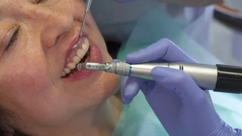 Dentist moves prophy cup across upper incisors Stock Footage 73575476