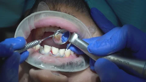 Dentist Performing Procedure Stock Footage 316914198