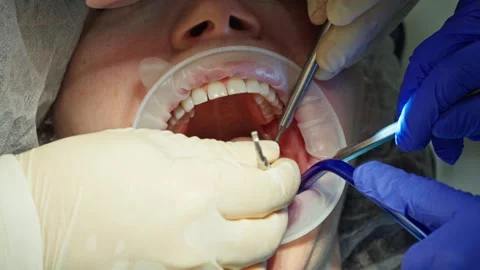 A dentist performs check of pin during the surgical stage of dental implant Vídeos de archivo 342079842