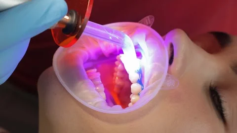 A dentist performs professional whitening of tooth enamel. Vertical video Stock Footage 250131132