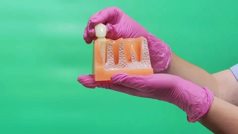 Dentist Placing Ceramic Crown on Prepared Tooth in Jaw Model Stock Footage 337106526