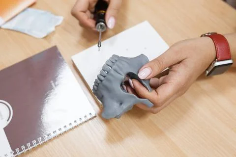 Dentist practice with mini screw model on dental model. Orthodontic dentistry Foto stock