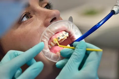 Dentist prepares patient's teeth Foto stock