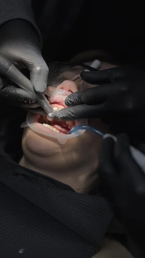 Dentist preparing front teeth for crowns in young woman. Dental restoration and Video stock 341704879