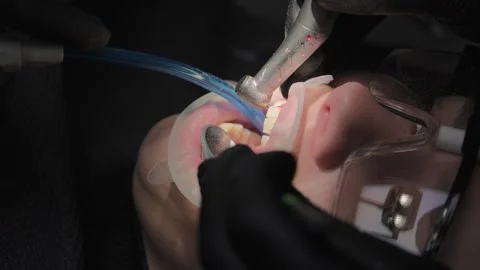 Dentist preparing teeth for dental crowns using a high-speed handpiece 스톡 동영상 339274241